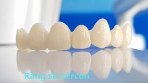 Răng sứ cercon