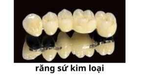 răng sứ kim loại