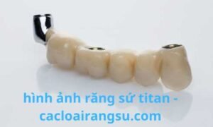hình ảnh răng sứ titan
