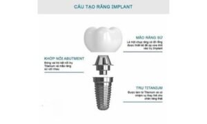 Chức Năng Các Bộ Phận Implant: Cách Từng Phần Hoạt Động