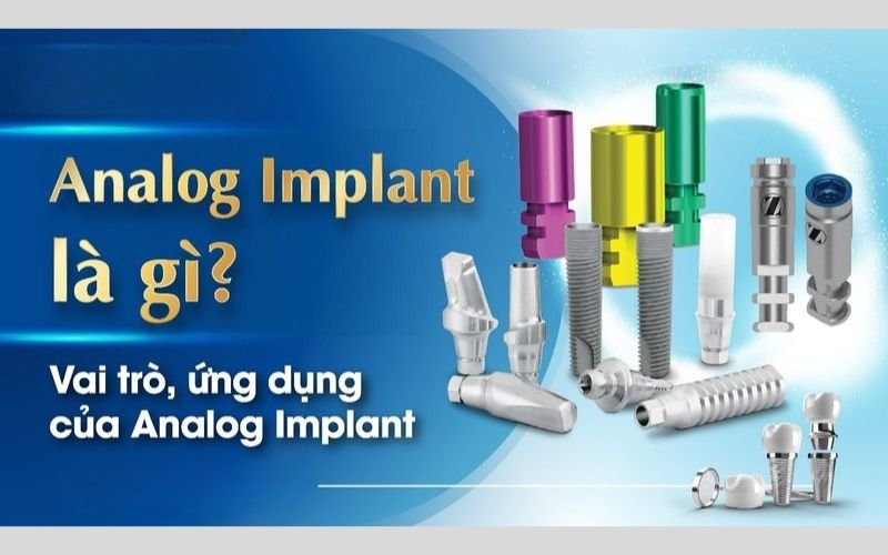 Chức Năng của Analog Implant trong Nha Khoa