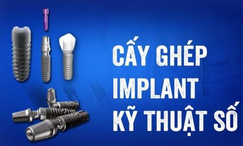 Phân Biệt Analog Implant và Implant Kỹ Thuật Số
