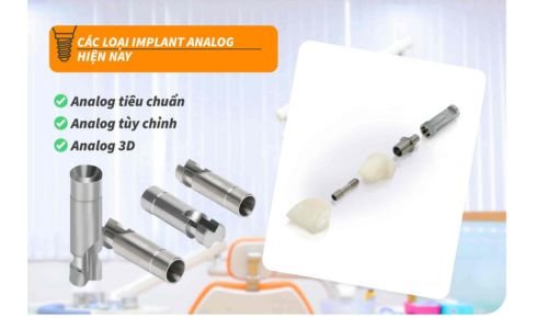 Phân Biệt Analog Implant và Implant Kỹ Thuật Số