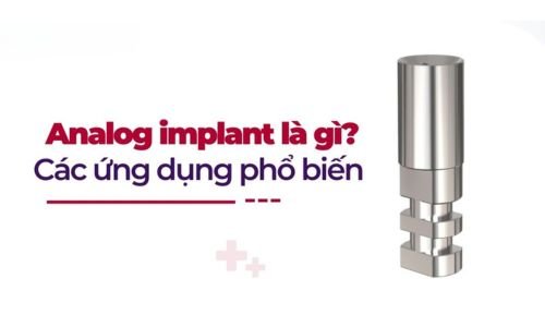 Ứng Dụng của Analog trong Phục Hình Implant