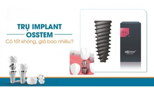 Chất lượng và độ bền của Implant Osstem