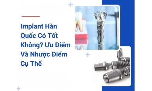 Khám Phá Ưu Điểm Nổi Bật Của Implant Hàn Quốc