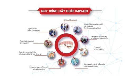 Quy Trình Cấy Ghép Implant Osstem: Từng Bước Để Đạt Kết Quả Hoàn Hảo