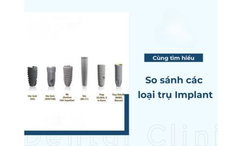 So sánh chi phí Implant Dentium và các thương hiệu khác