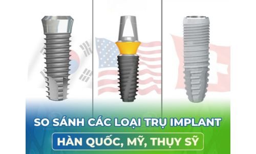 So sánh Implant Hàn Quốc với các dòng Implant quốc tế