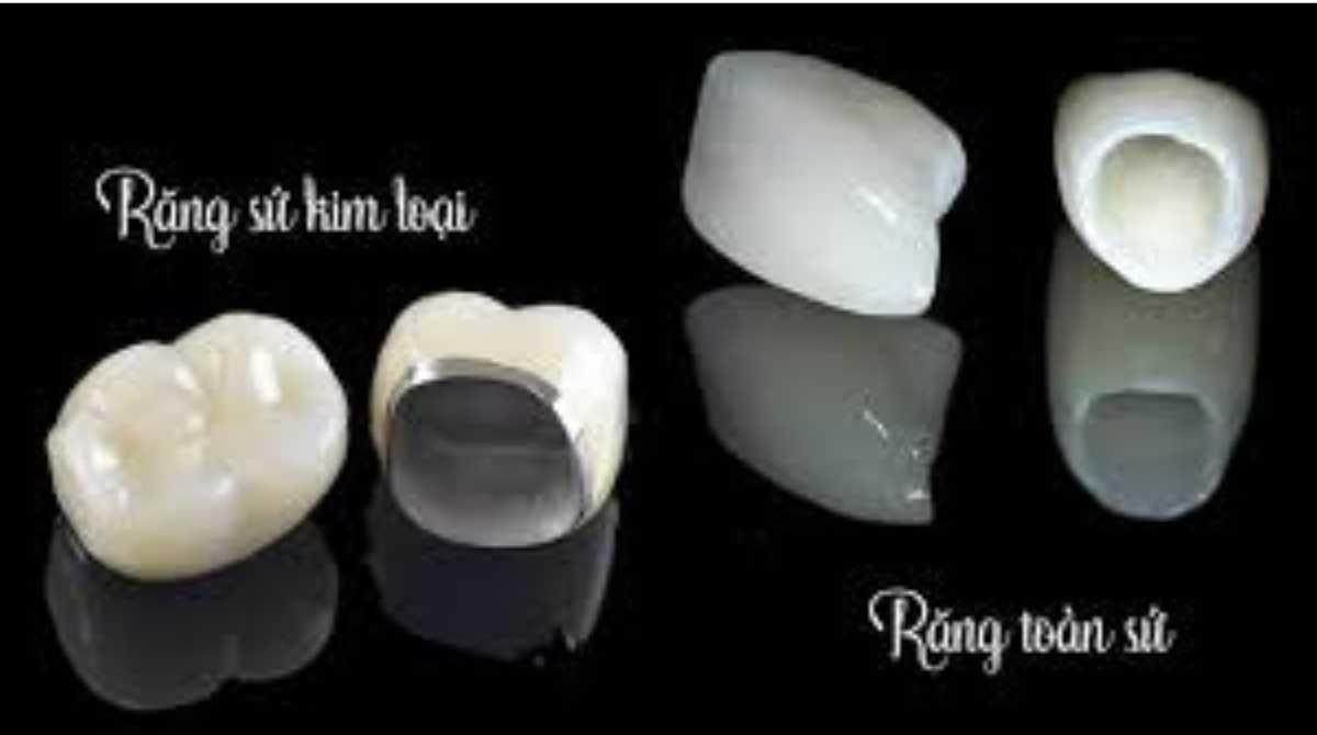 răng sứ kim loại titan và răng toàn sứ