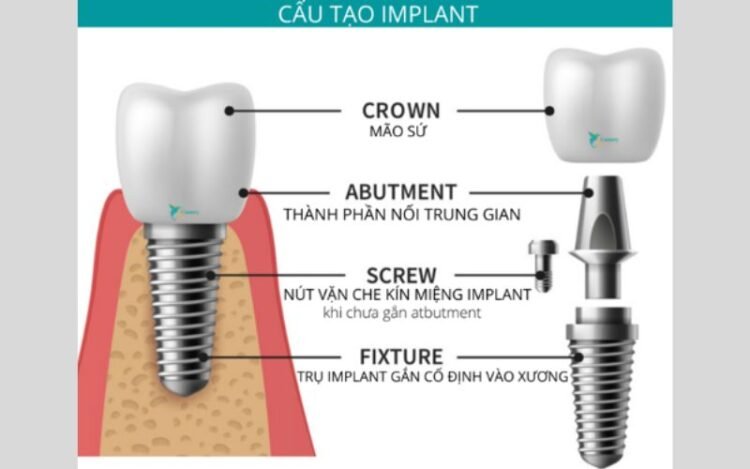 Thành Phần Của Trụ Implant Điểm Cơ Bản Cần Biết