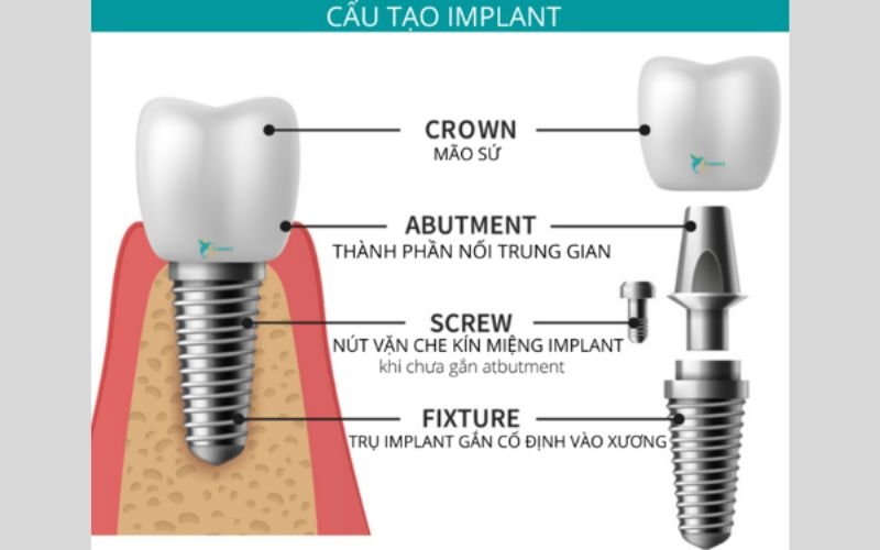 Thành Phần Của Trụ Implant Điểm Cơ Bản Cần Biết